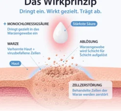 Acetocaustin Lösung Warzenmittel 2 ml