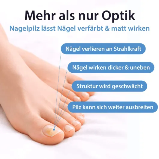 Acetocaustin Nagelpilz Lösung mit Aufhellung 9 ml