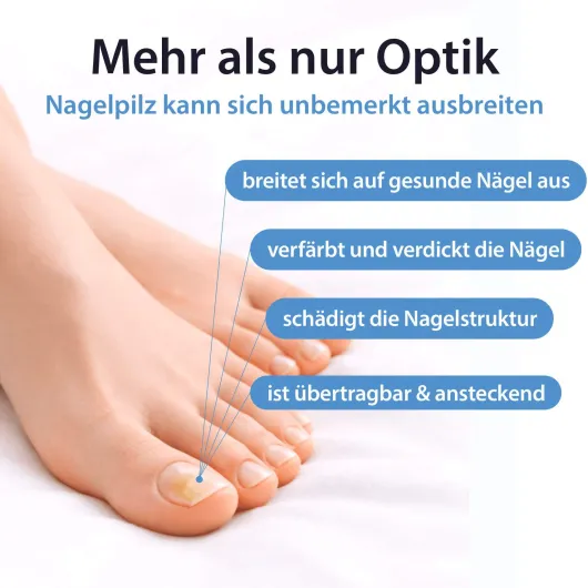 Acetocaustin Nagelpilz Stift 4 ml