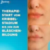 Zovirax Lippenherpescreme 2 g